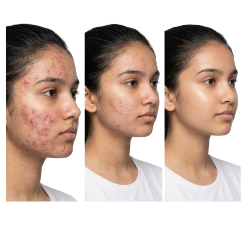 Pimples & Scars Treatment